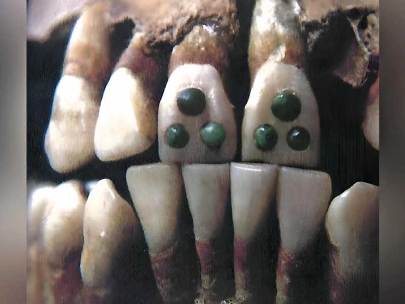 Um exemplo de modificação dentária por incrustação. Crédito: Emmashavrick / CC BY-SA 4.0