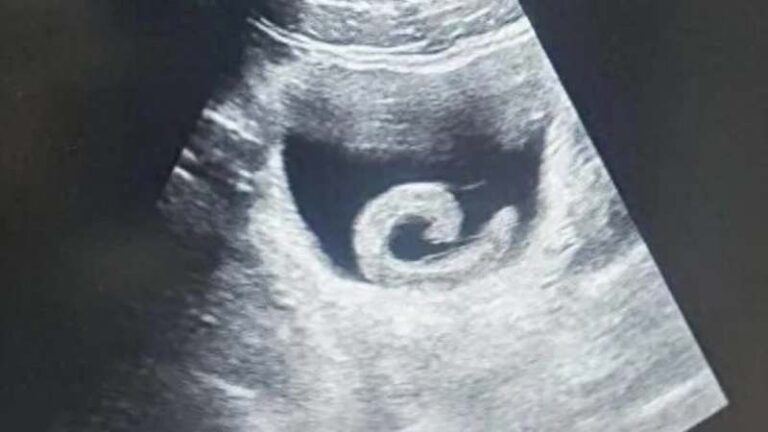 Homem insere sanguessuga viva na bexiga como “tratamento tradicional”