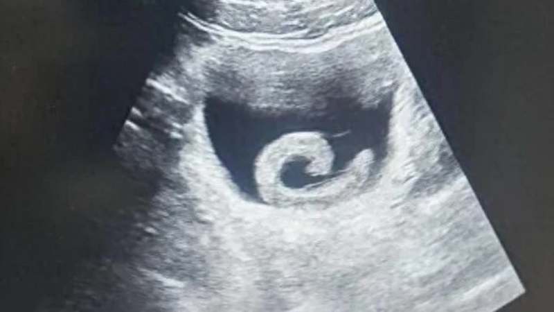 Homem insere sanguessuga viva na bexiga como “tratamento tradicional”